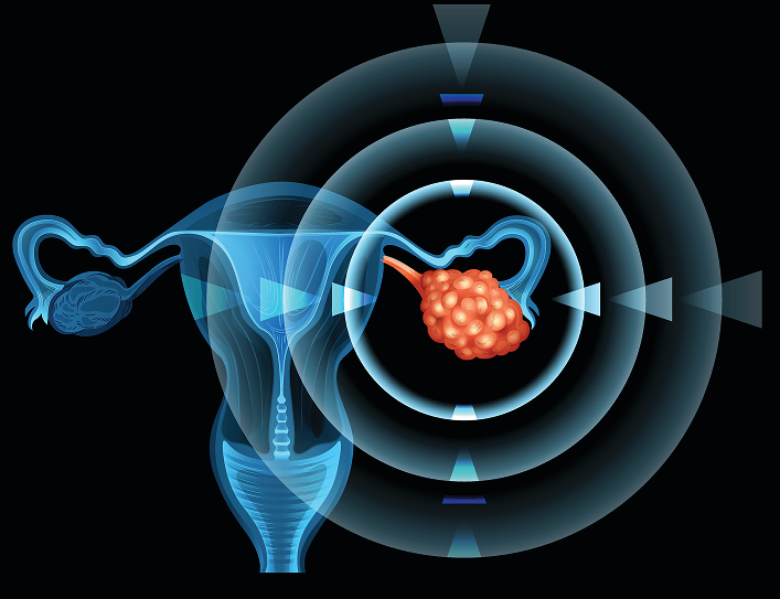 Brain Tumor 2